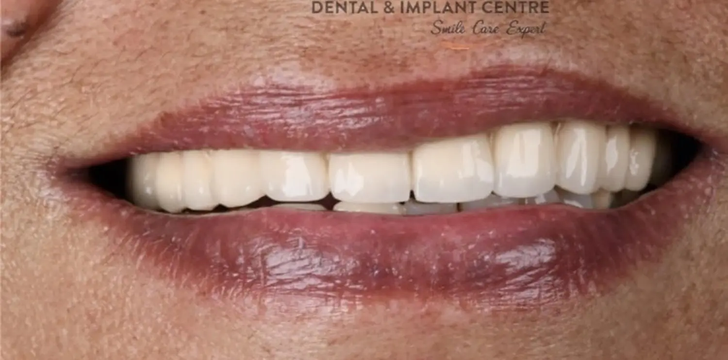 Full Dental Implant Results